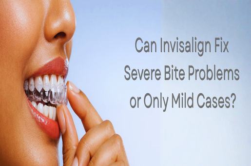 Can Invisalign Fix Severe Bite Problems or Only Mild Cases?